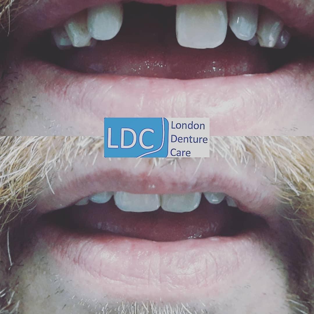Acrylic  Lower Denture