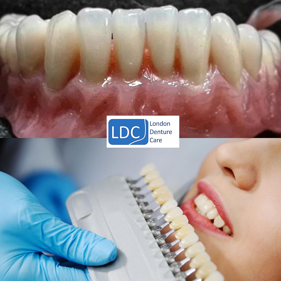 Partial Dentures in London, UK Dentists & Laboratory