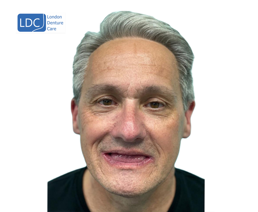 https://londondenturecare.com/wp-content/uploads/2025/01/teeth-after2.jpg